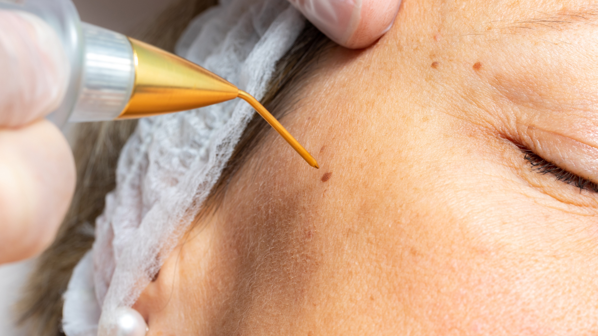 A person receives a cosmetic treatment on their face, with a close-up view of the skin near the eye. A medical professional is holding a syringe filled with a golden liquid, injecting it into a small mole or blemish on the person's cheek, with a focus on the procedure.
