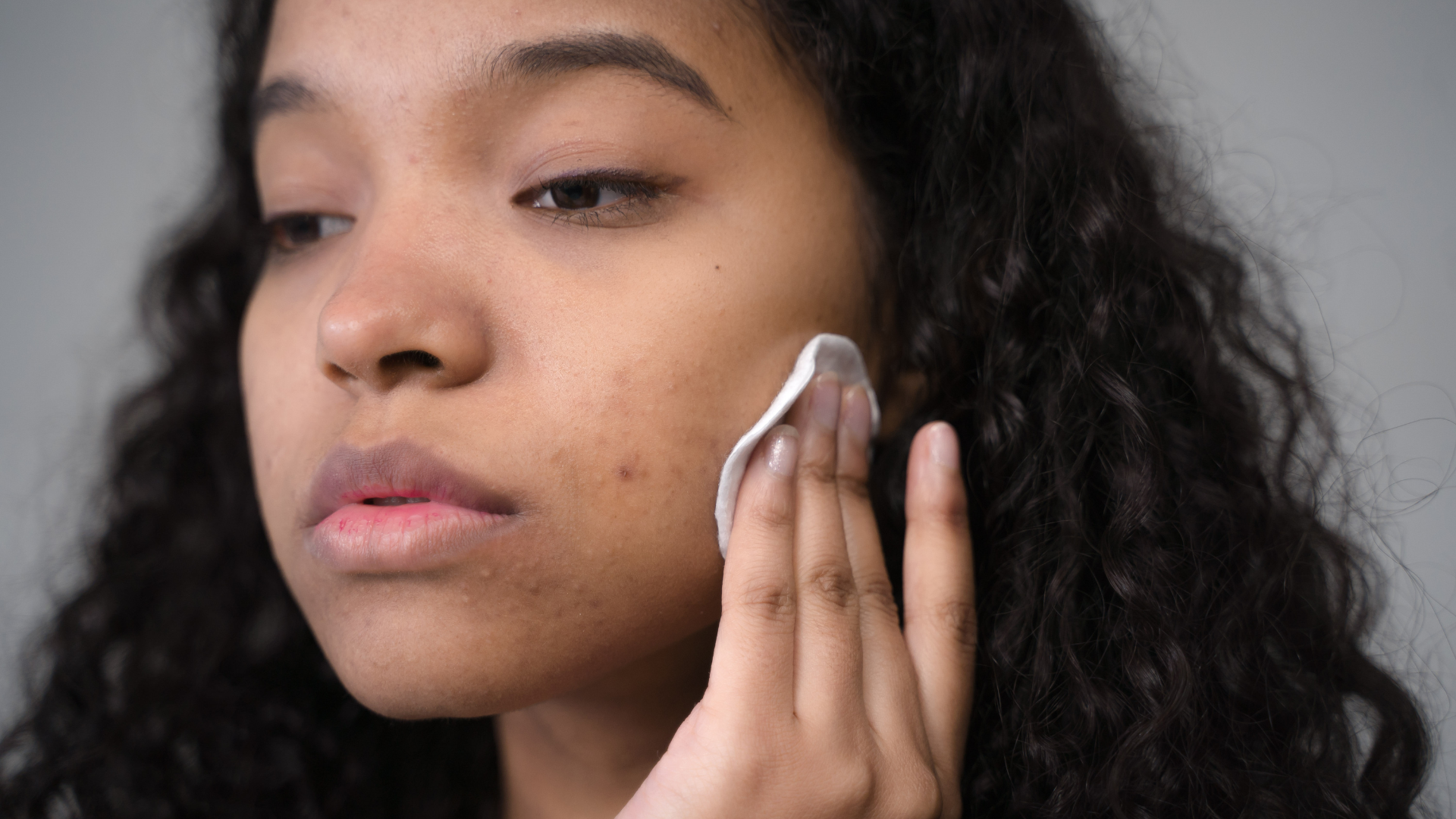 A woman with skin blemishes cleansing her face with a cotton pad.