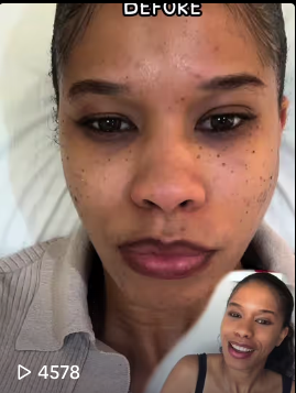 A woman with dark undereye circles, acne scars, and a neutral expression during a video call, with a small inset image of her smiling.