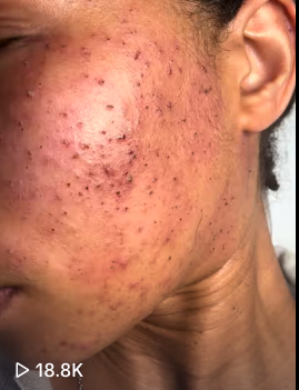 Close-up of a person's cheek with severe acne and inflammation.