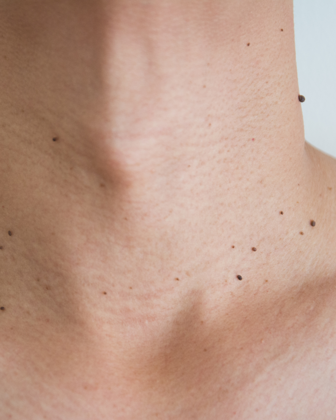 Skin Blemishes.png