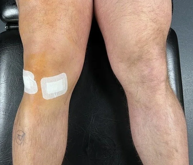 A person's legs lying on a black examination table, with bandages on their left knee indicating a recent injury or surgery.