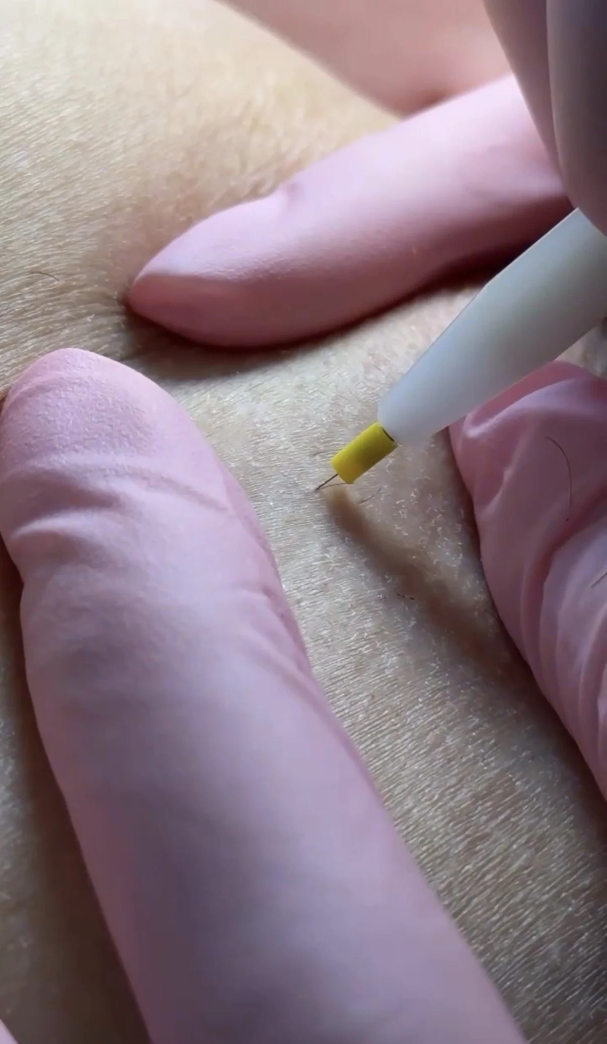 Facial Hair Removal in Brooklyn: Laser vs Electrolysis for Chin, Lip &amp; Face