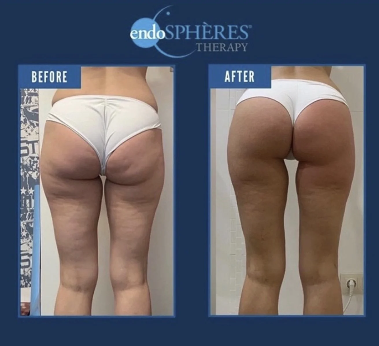 Endospheres Therapy in Brooklyn: What to Expect from a Body Contouring Session