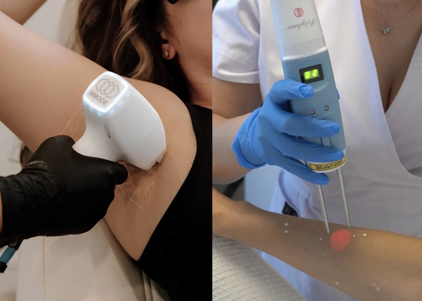 Laser hair removal treatments with handheld laser devices