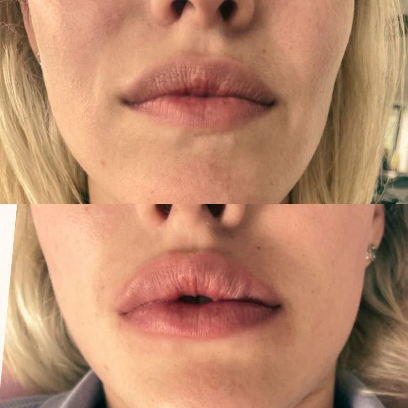 Before and after front profile image of a woman's lips following filler treatment to creating the tenting lip image at a skin rejuvenation clinic in Broadstone