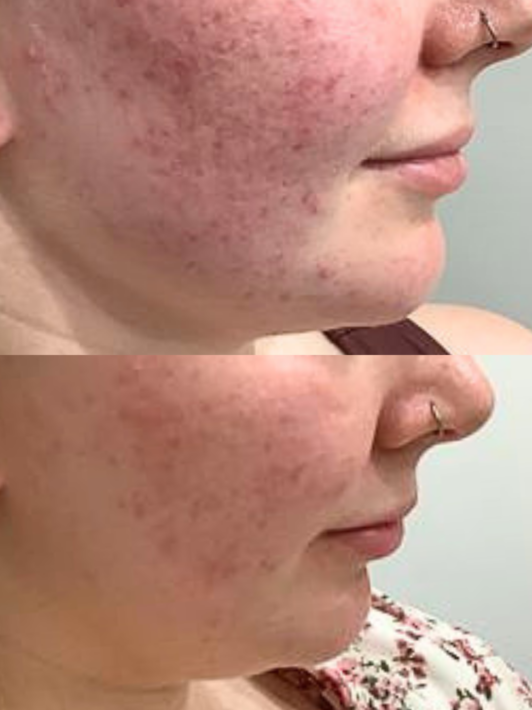 A before and after of a woman's lower face showcasing the brilliant results of face peels and advanced skincare products at a skin clinic in poole