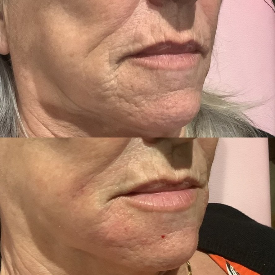 Before and after side profile image of a woman's lower face following filler to improve deep mouth lines and wrinkles at a skin rejuvenation clinic in Broadstone