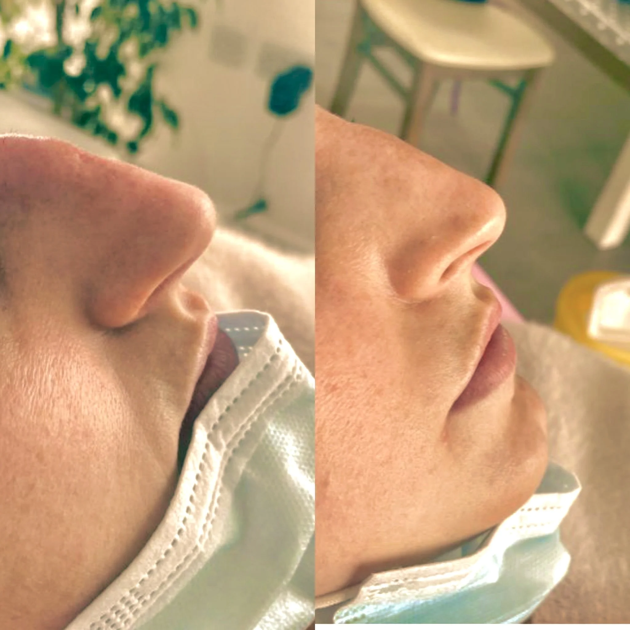 Before and after comparison of a non-surgical rhinoplasty using dermal filler to smooth out a prominent nose hump