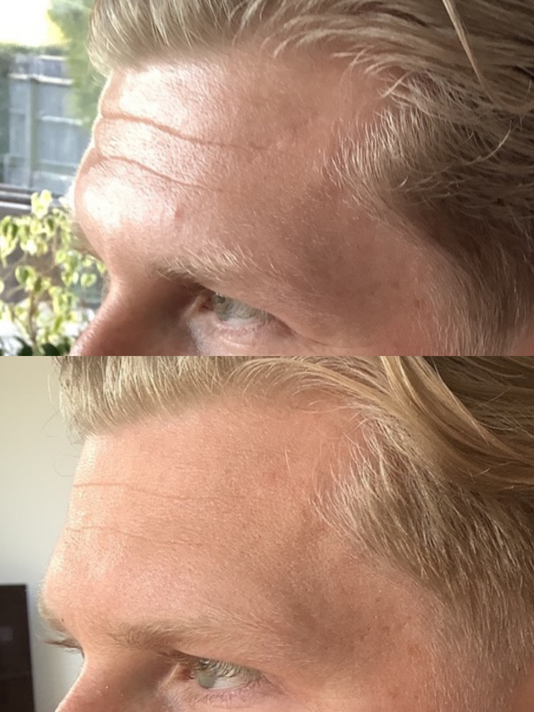 A before and after of a man's forehead showcasing the brilliant results of botox to reduce forehead lines at a skin rejuvenation clinic bournemouth