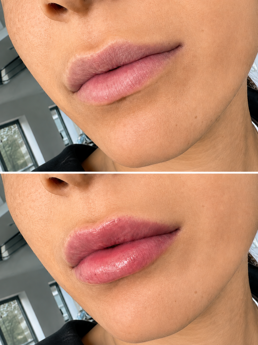 Before and after results of a dermal filler treatment enhancements lips