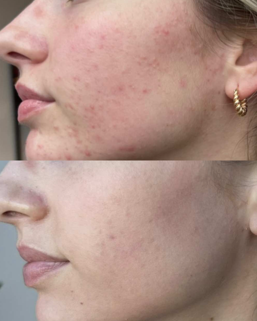 A before and after side profile image of a woman having had microneedling treatment to minimise the appearance of acne and acne scars at a clinic in Bournemouth