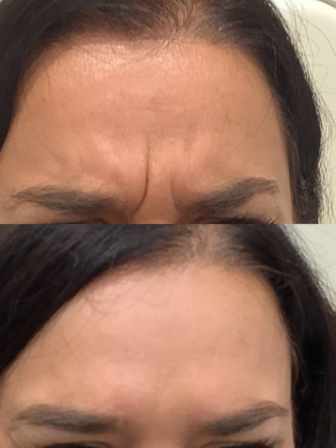 A before and after of a woman's forehead showcasing the brilliant results of botox to reduce forehead lines at a skin rejuvenation clinic bournemouth