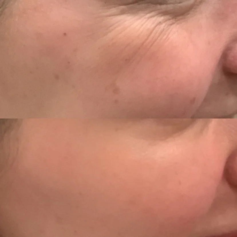 Before and after results botox treatment to minimise the appearance of crow's feet