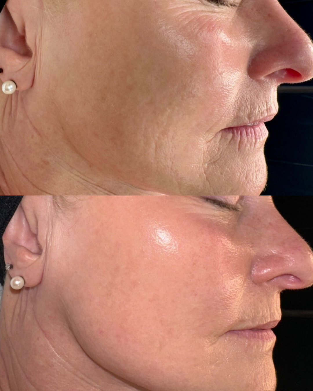 Before and after side profile image of a woman's face having had microneedling treatment to rejuvenate skin and boost collagen at a skin clinic in bournemouth