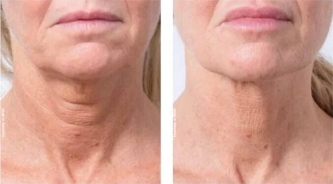 Before and after image of a woman's decolletage following profhilo filler treatment to rejuvenate the neck at a skin rejuvenation clinic in broadstone