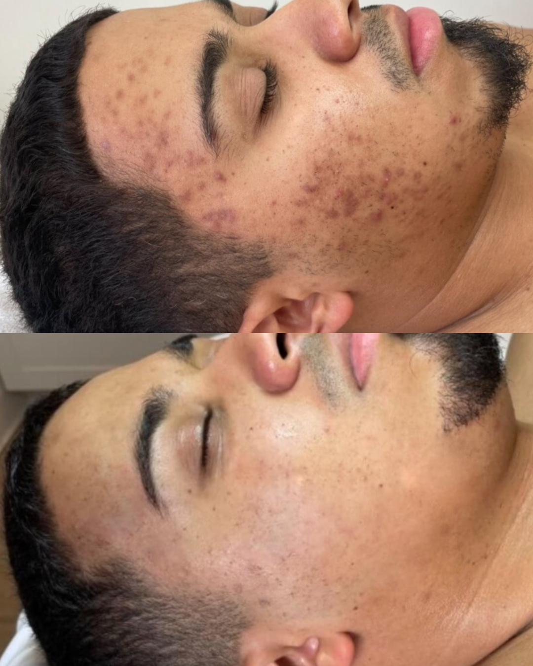 Before and after comparison of a male patient’s cheek, showing reduced acne scarring and smoother skin texture after microneedling treatments