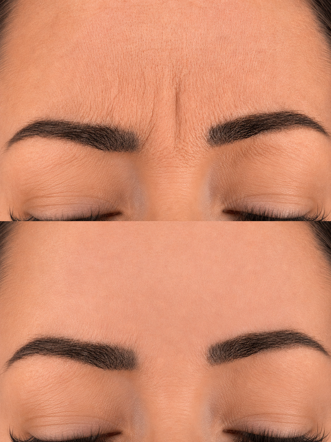 A before and after of a woman's forehead showcasing the brilliant results of botox to minimising number 11 lines at a skin rejuvenation clinic bournemouth