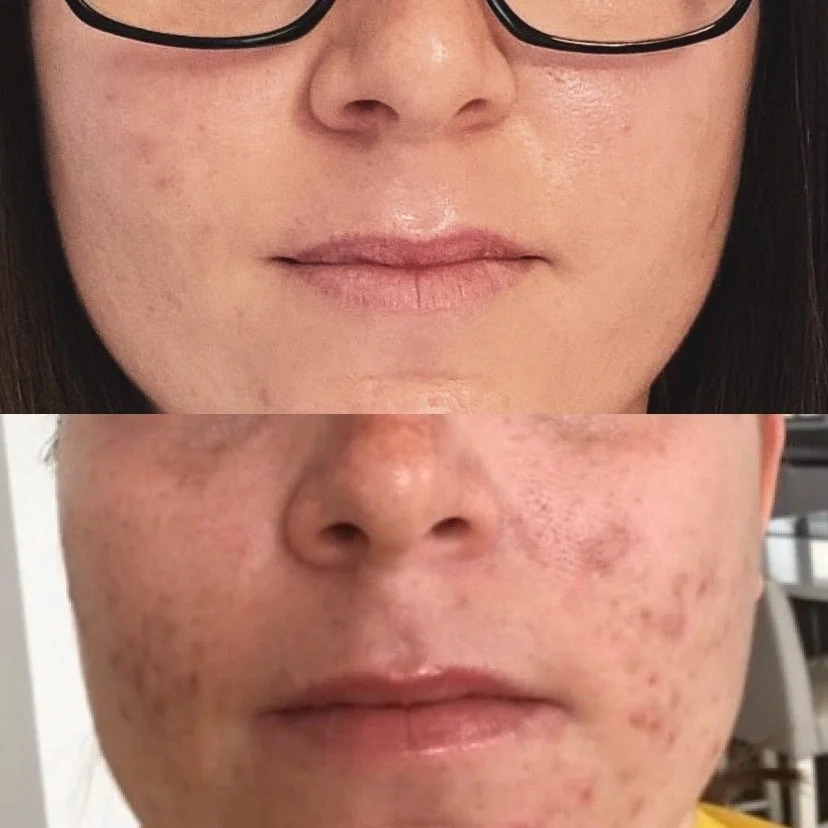 A before and after front profile image of a woman's lower face showcasing the brilliant results from skin peels and a daily advanced skincare routine