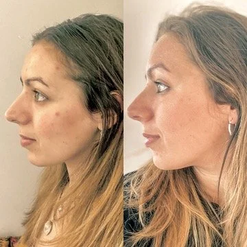 A before and after side profile image of a young woman showcasing the brilliant results from a skin peel and using advanced skincare products