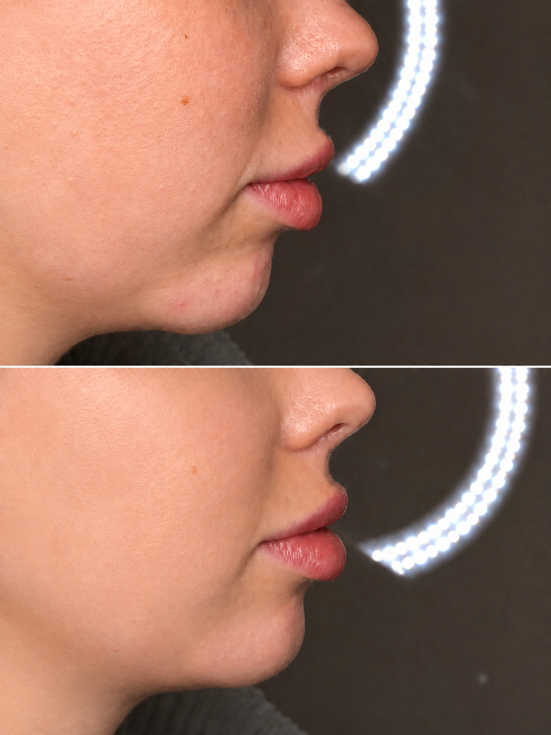 Side profile comparison showing before and after a dermal filler chin augmentation to improve jawline definition