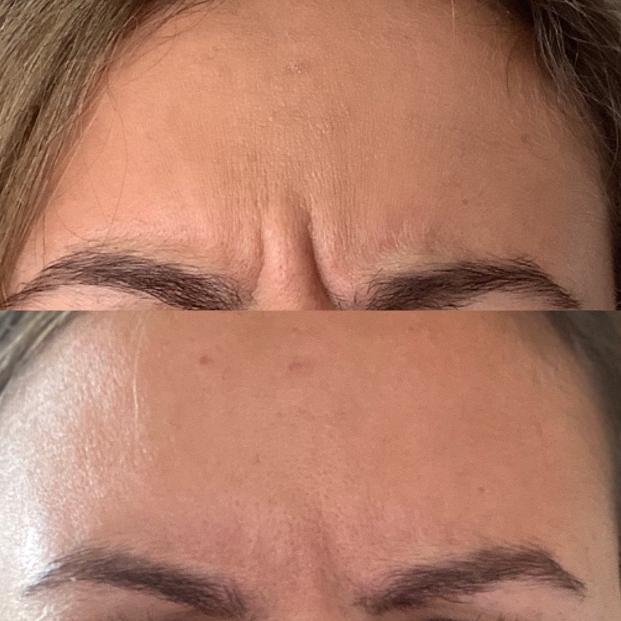 A before and after of a man's forehead showcasing the brilliant results of botox to reduce forehead lines at a skin rejuvenation clinic bournemouth