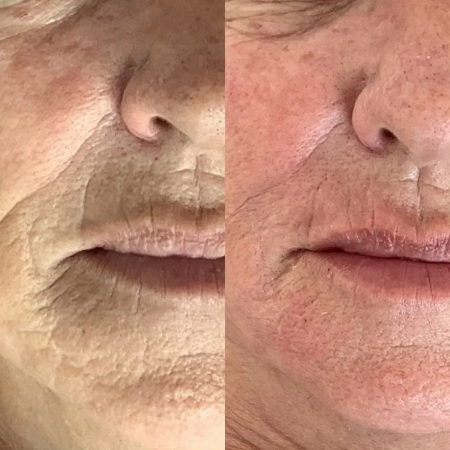 Before and after results of botox treatment smoothing out face wrinkles