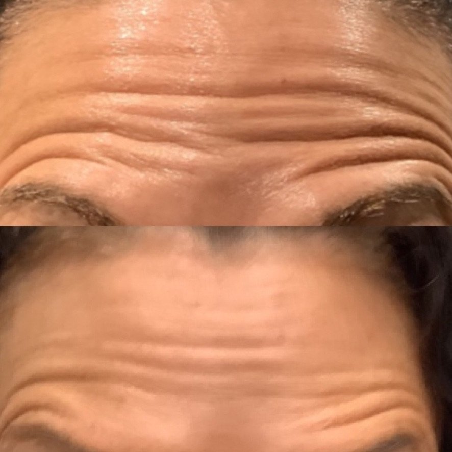 A before and after of a woman's forehead showcasing the brilliant results of botox to reduce forehead lines at a skin rejuvenation clinic bournemouth