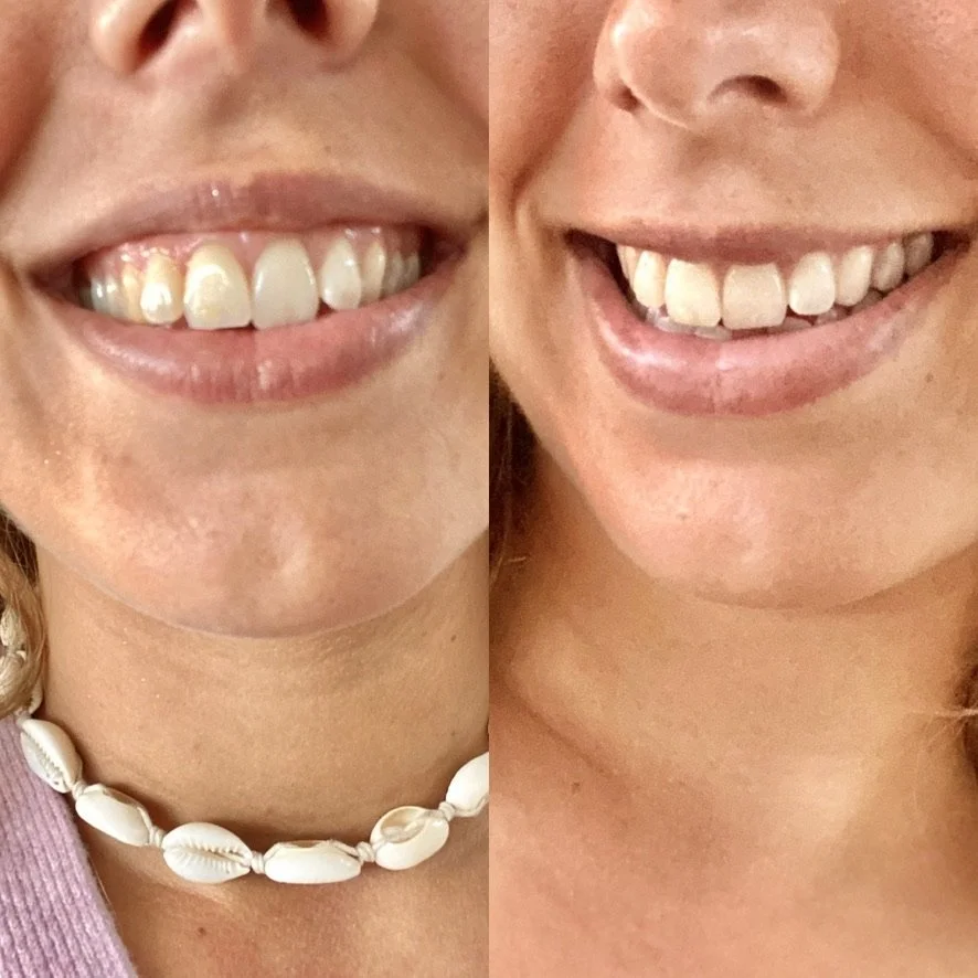 A before and after of a woman's smile showcasing the results of botox to reduce gummy smile at a skin rejuvenation clinic bournemouth