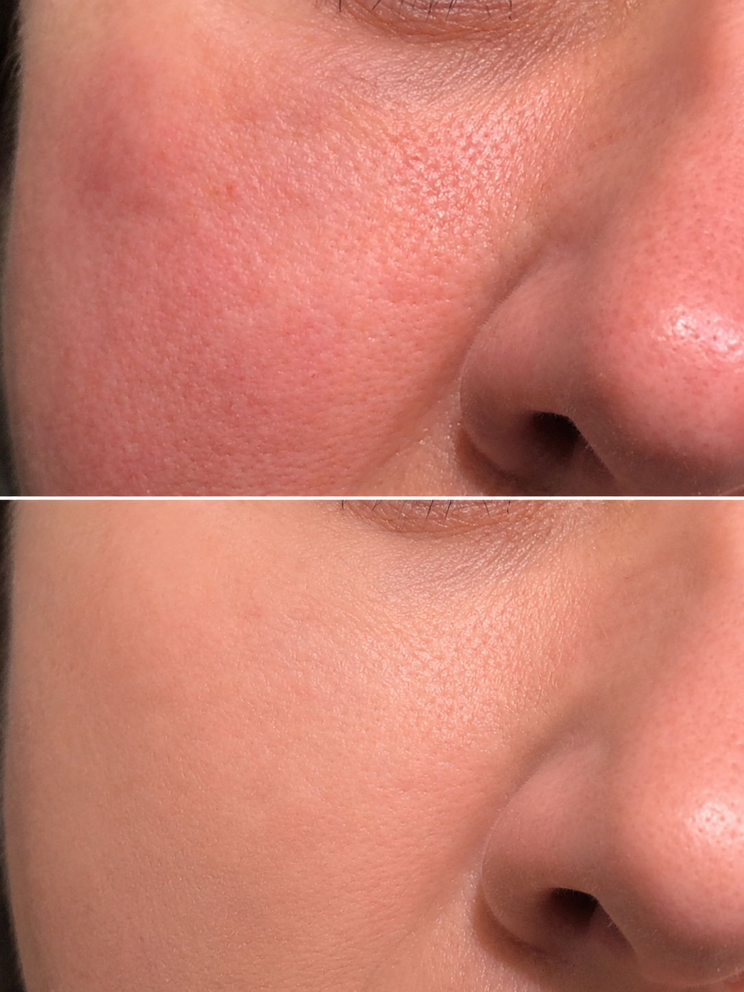 Before and after front profile image of a woman's cheeks following filler to add volume to the cheek area at a skin rejuvenation clinic in Broadstone