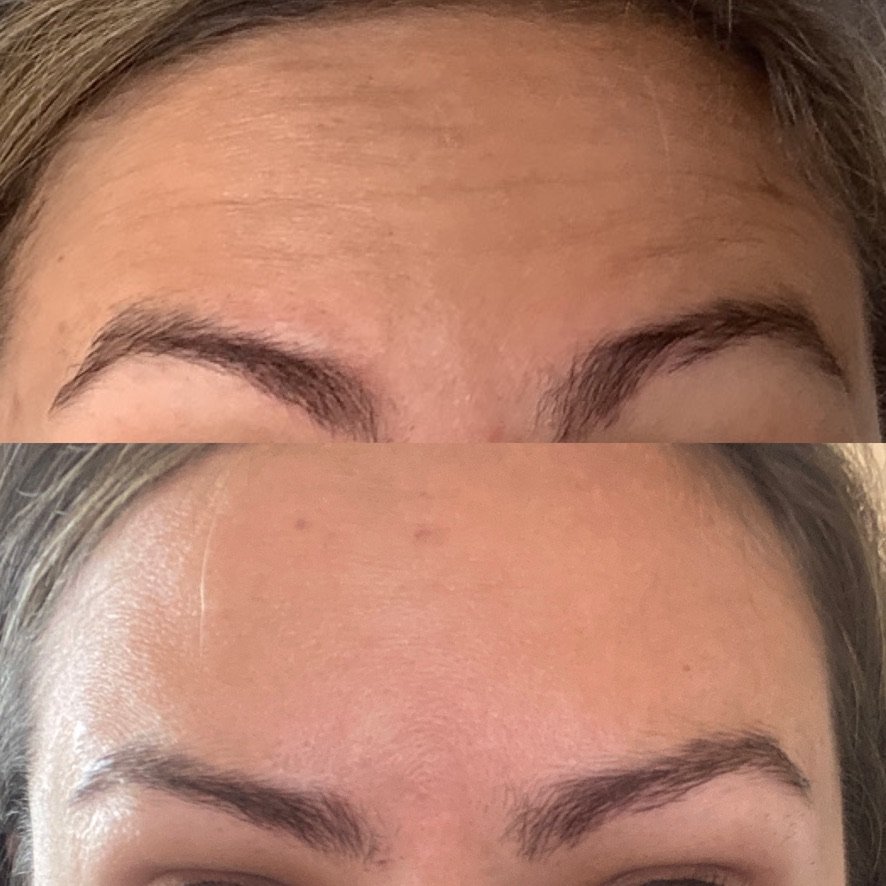 A before and after of a woman's forehead showcasing the brilliant results of botox to reduce forehead lines and migraines at a skin rejuvenation clinic broadstone