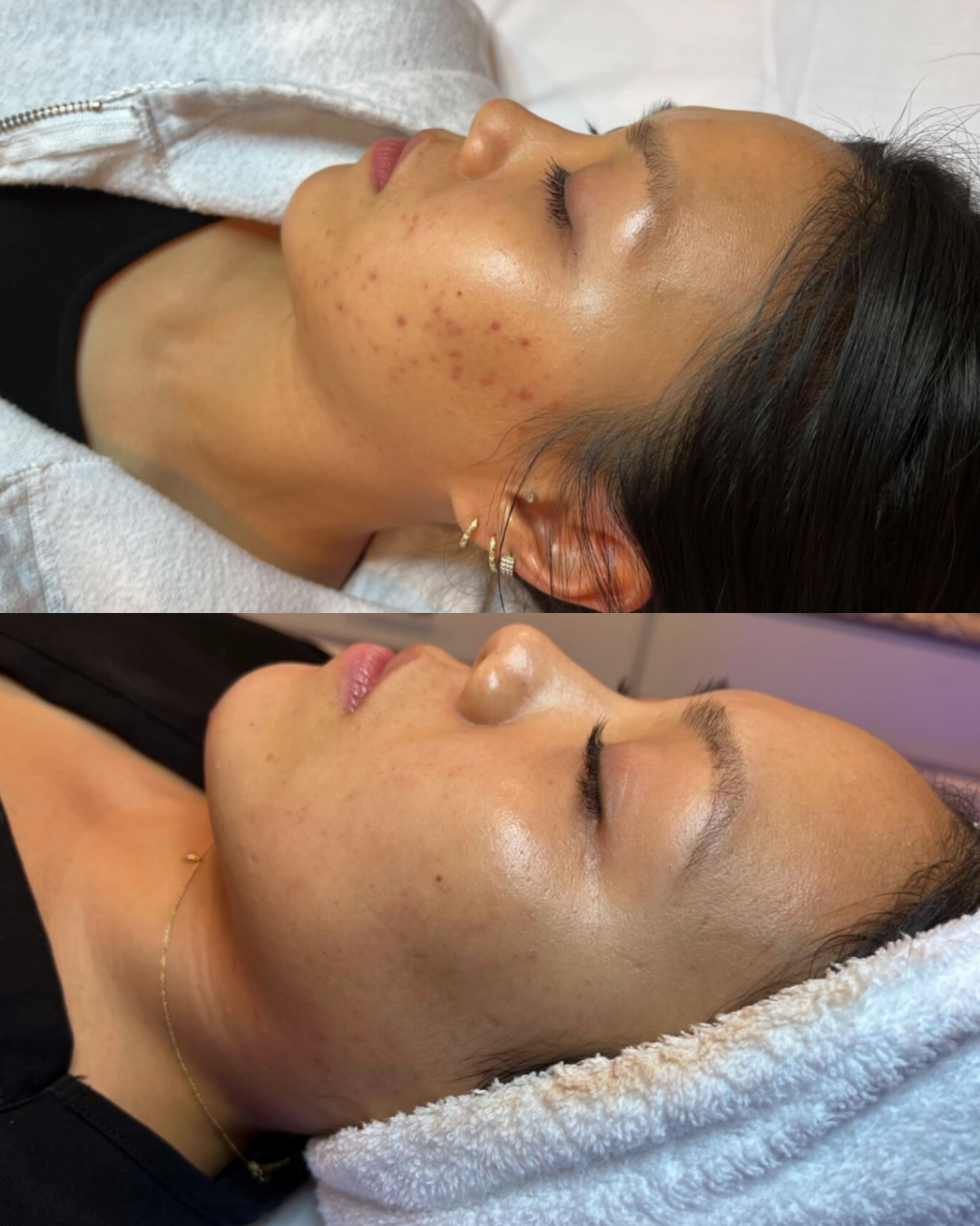 Before and after side profile image of a woman's face having had microneedling treatment to reduce the appearance of acne and acne scarring at a skin clinic in bournemouth