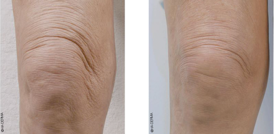 Before and after photo of a knee following profhilo treatment at a skin rejuvenation clinic in bournemouth to smooth knee lines