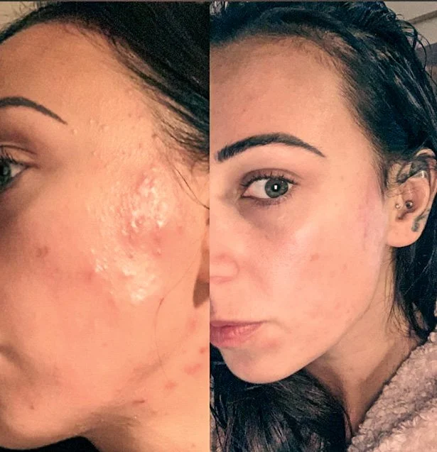 A before and after side profile image of a young woman showcasing the brilliant results from a skin peel and using advanced skincare products