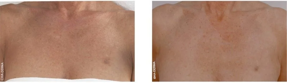 Before and after image of a woman's decolletage following profhilo filler treatment to rejuvenate the neck at a skin rejuvenation clinic in bournemouth