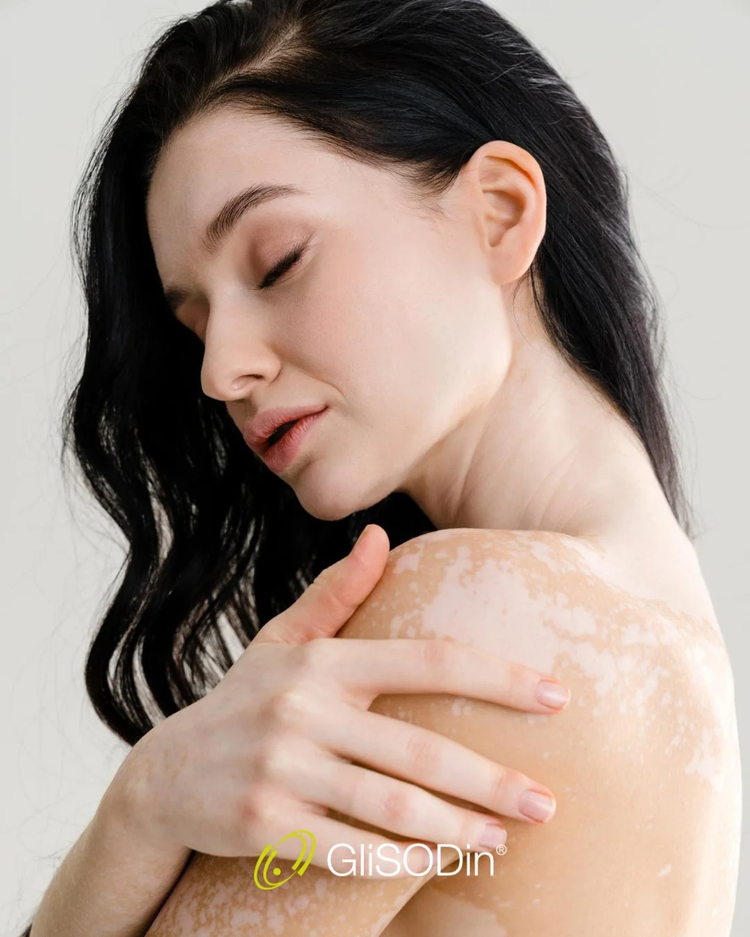 7_vitiligo.jpeg