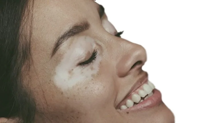 VSOD_skin_LS.jpg