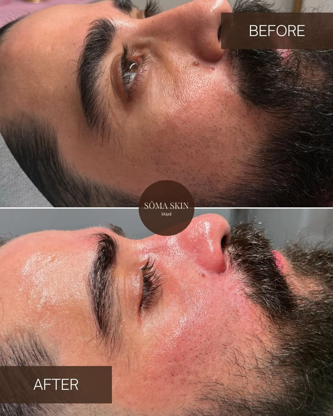 Side-by-side comparison of a man's facial skin before and after a skincare treatment. The top image labeled 'BEFORE' shows the skin with visible pores and uneven texture. The bottom image labeled 'AFTER' shows smoother, more hydrated skin with diminished pore appearance.