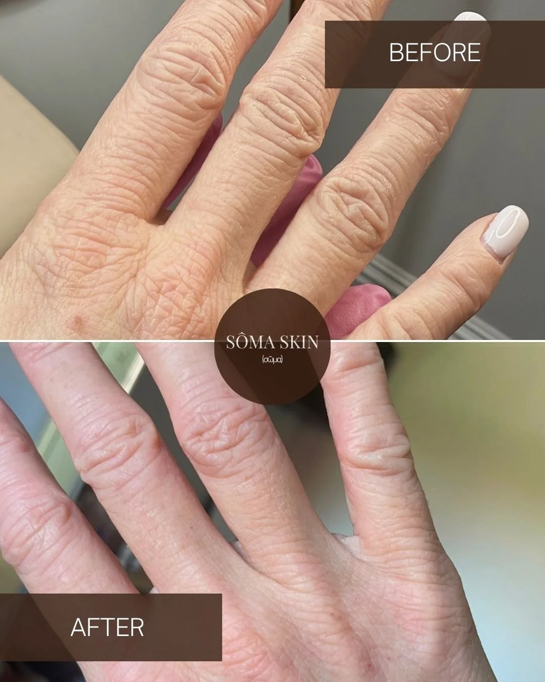 Comparison of a hand showing dry, wrinkled skin before and smoother, hydrated skin after skincare treatment. 'Before' image on top and 'After' image on bottom, with text indicating 'SOMA SKIN'.