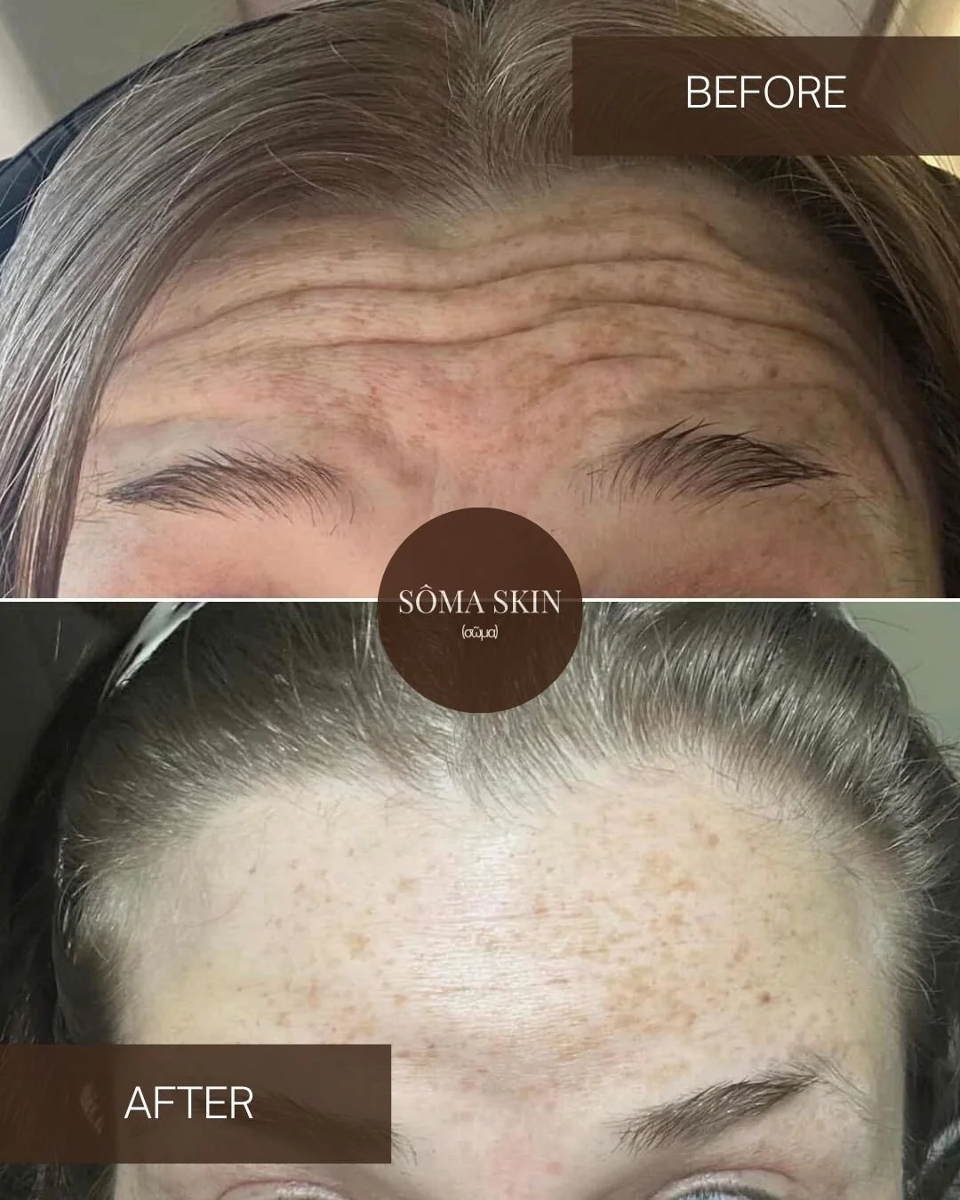 Comparison image showing a forehead with wrinkles in the 'before' section and smooth, clear skin in the 'after' section, with the text 'SÔMA SKIN' in the center.