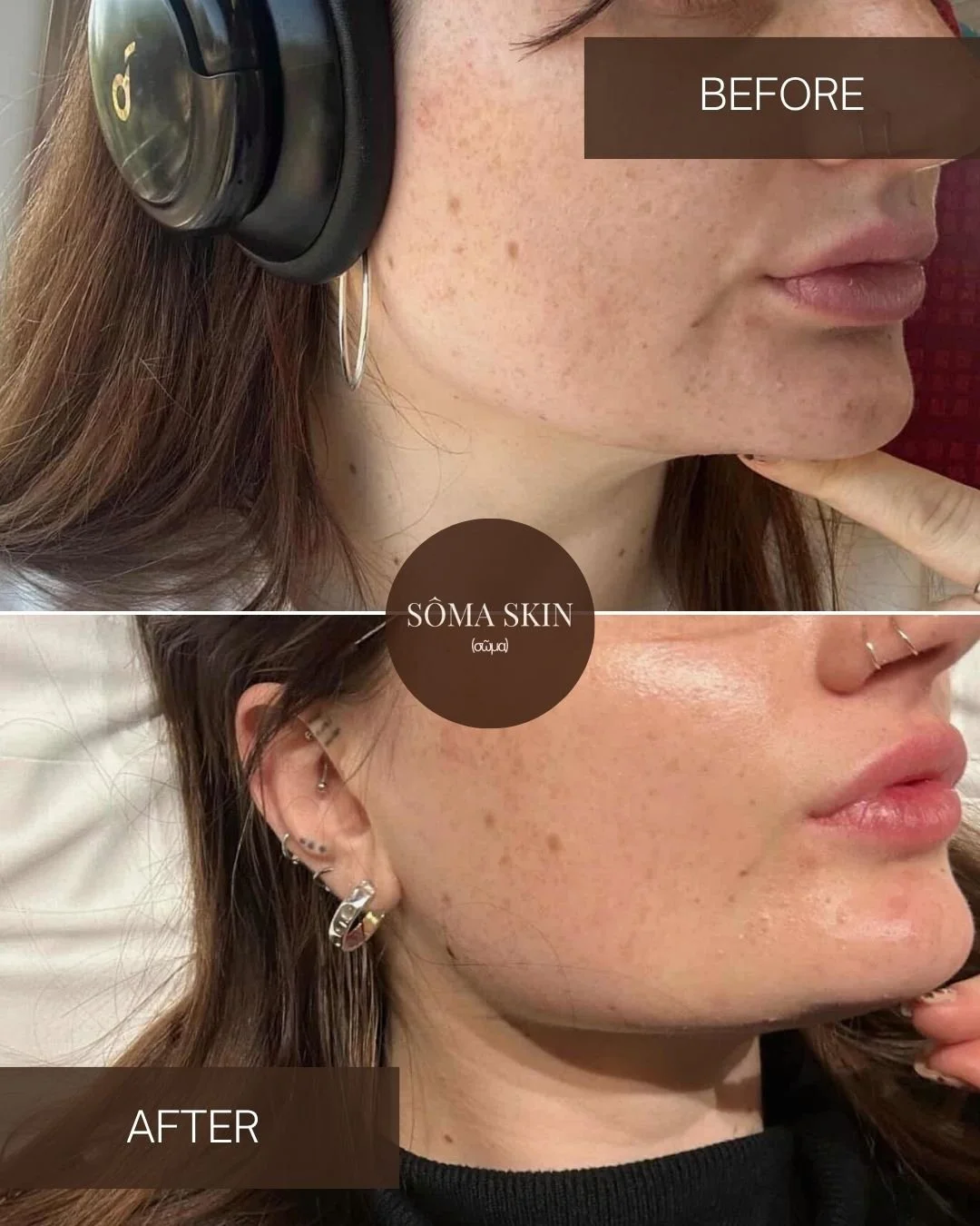 Before and after photo showing improvement in skin clarity and texture, focusing on a woman's cheek and lower face, with the label 'BEFORE' on the top image and 'AFTER' on the bottom image, and a circle in the center with the text 'SÔMA SKIN'.