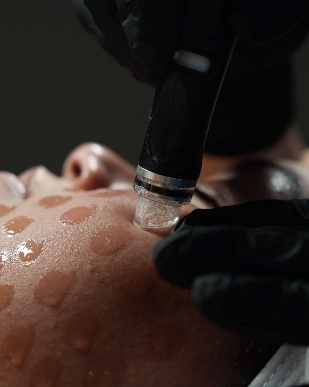 A close-up of a person receiving a facial treatment with a professional using a device to extract or treat their skin, with visible water droplets on the face.
