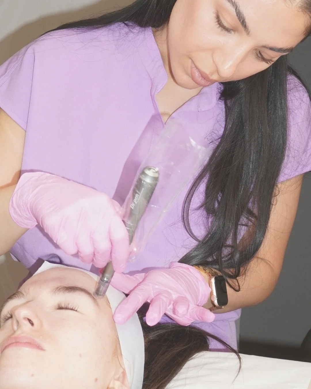 Microneedling treatment at Soma Skin Chelsea