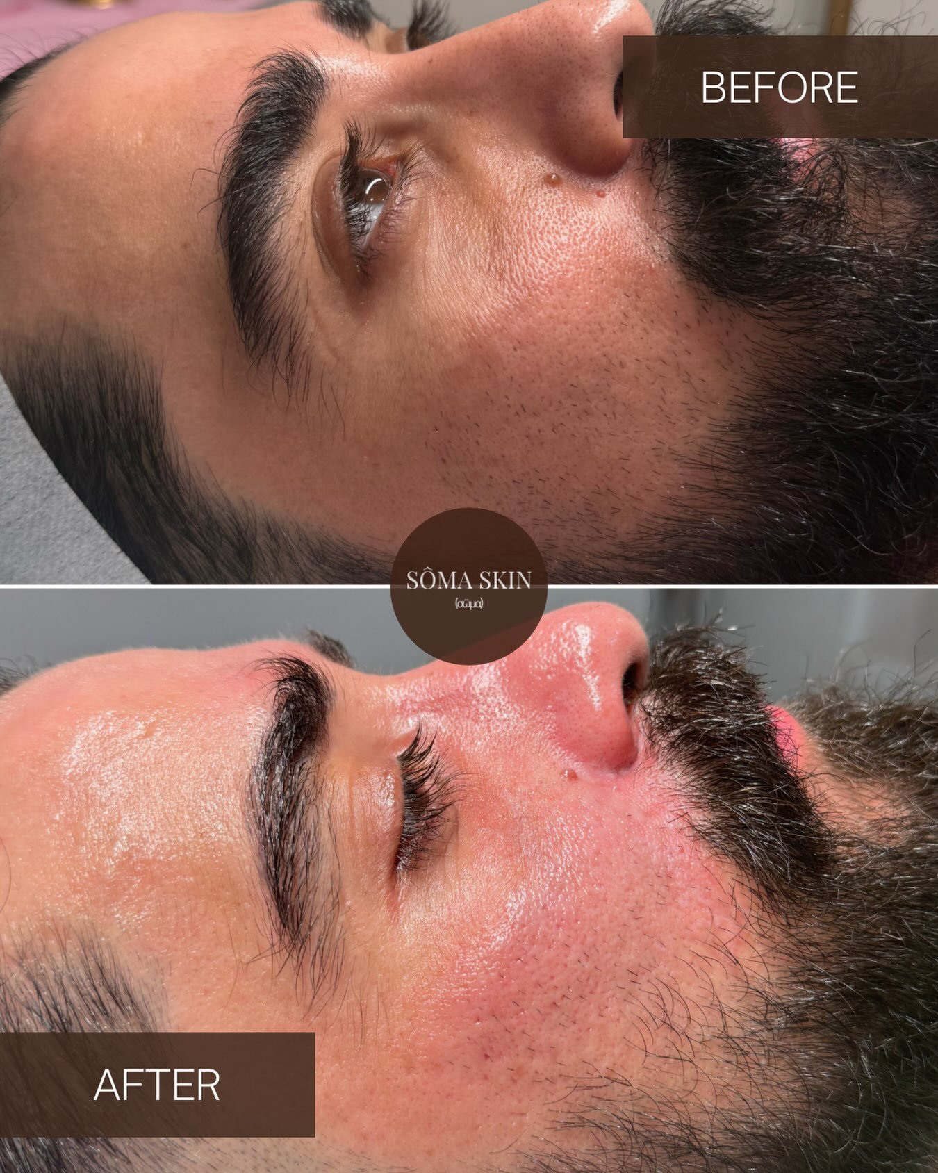 Pigmentation, to refined skin tone.

A targeted pigment peel to help brighten uneven tone, improve the appearance of pigmentation &amp; post-inflammatory marks.

Before &rarr; After 2nd session 

Skin that looks clearer, brighter &amp; more even. 

S