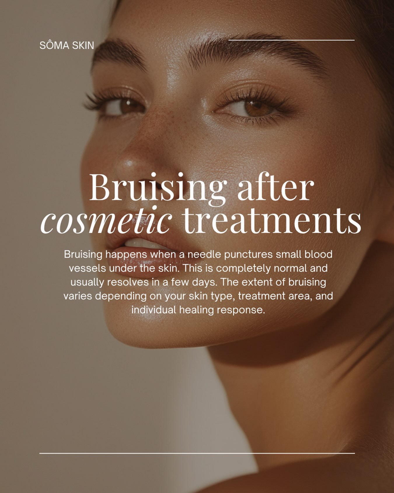 Bruising after injectables? Here&rsquo;s how to minimise it 

BEFORE YOUR APPOINTMENT

* Avoid alcohol for 24&ndash;48 hours
* Avoid aspirin/ibuprofen (unless prescribed)
* Inform your practitioner of any medications or supplements
* Avoid scheduling