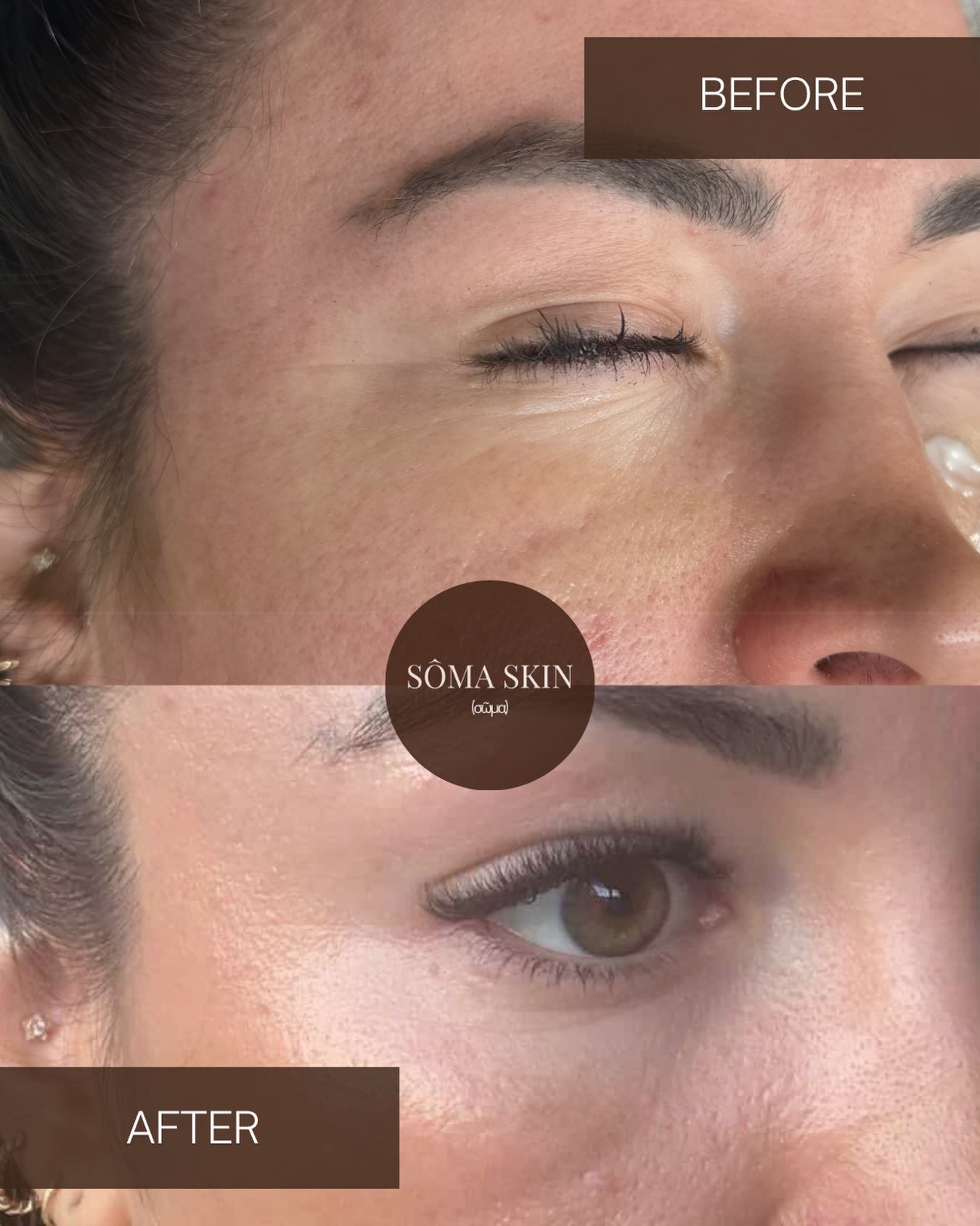 A beautiful example of what targeted under-eye polynucleotides can do.

Plinest I works by supporting the skin&rsquo;s natural regenerative processes, helping to improve:

* Hydration &amp; skin quality
* Fine lines &amp; crepey texture
* Elasticity 