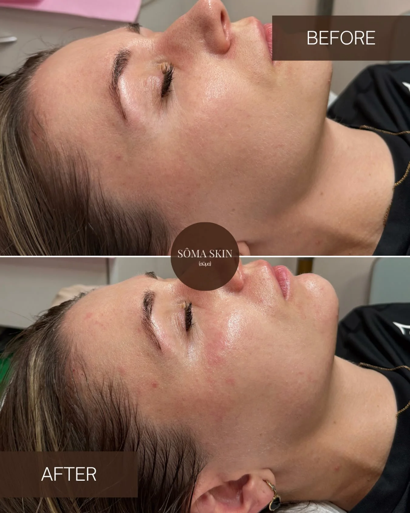 First session. Visible skin renewal. ✨

Microneedling + polynucleotides a powerful combination for improving skin quality from within.

This first-session result shows a more glowy, hydrated and refined complexion, with the skin appearing smoother an