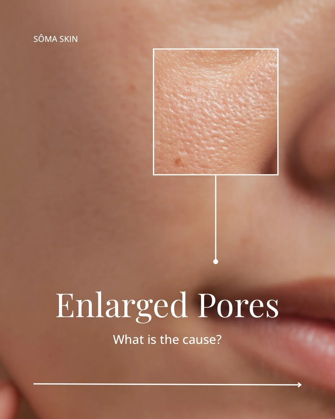 PORES &ne; DIRTY SKIN.

If your pores are looking bigger lately, it&rsquo;s not necessarily because your skin is &ldquo;dirty&rdquo; or needs a more aggressive scrub.

There are a few reasons pores can appear more visible:

&rarr; Excess oil producti