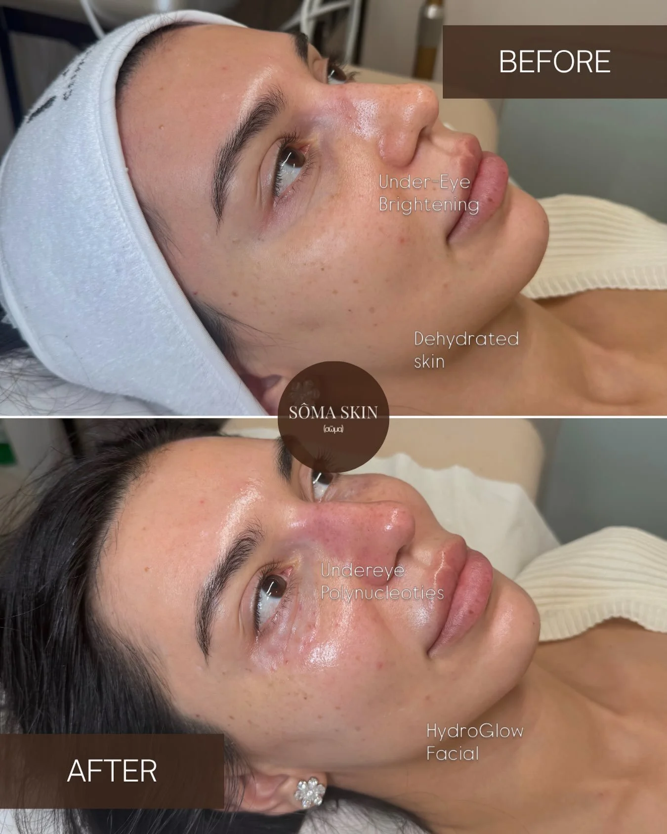 The best treatment plan is the one created for your skin.

For our clients first appointment, we focused on two things: restoring hydration and improving the quality of the under-eye area.

HydroGlow provided a fresh, hydrated base, alongside under-e