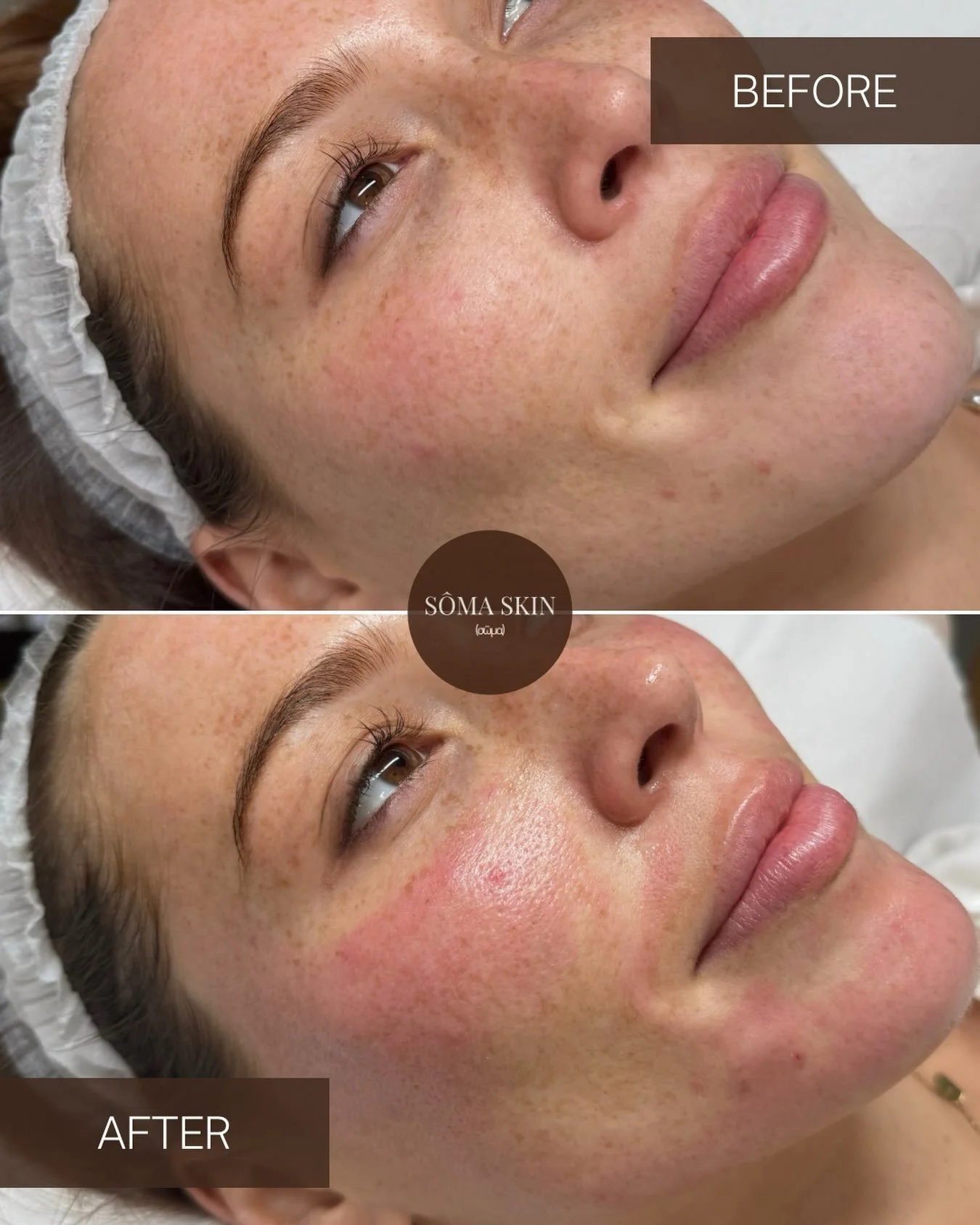 Microneedling, but with a little extra ✨

Our microneedling + Botox treatment with our Dermapen4 is designed to target fine lines, pores and uneven texture while giving the skin that fresh, smooth, glass-like finish.

Skin looks smoother, fresher and